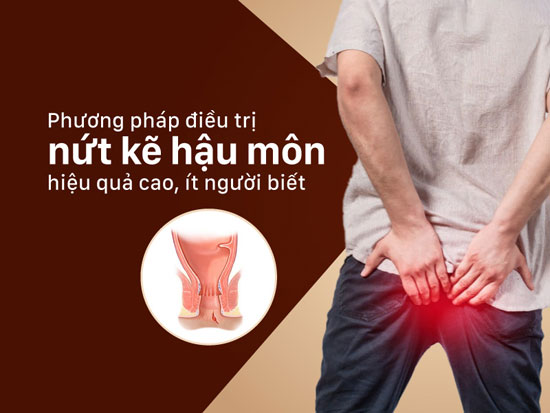 12 Cách điều trị nứt kẽ hậu môn ở nam và nữ hiệu quả hiệu quả